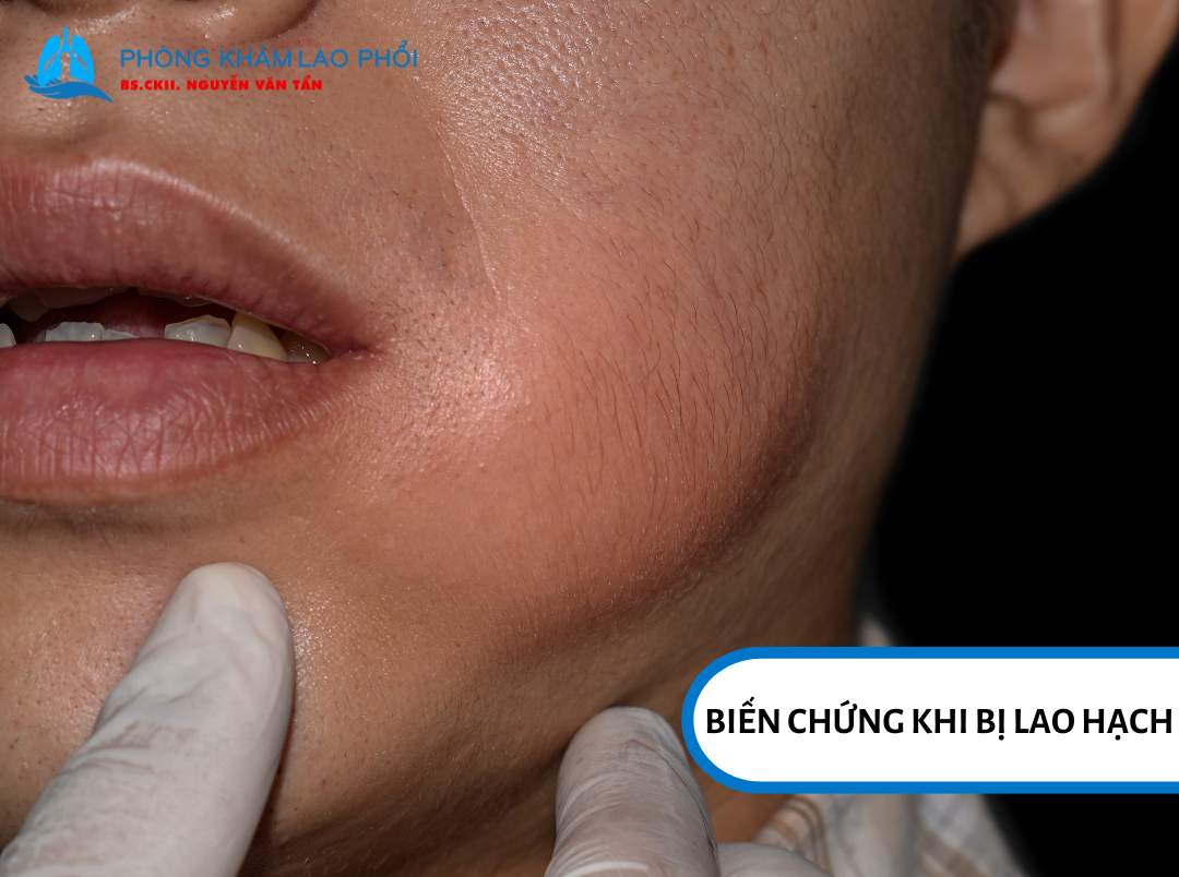 Biến chứng lao hạch