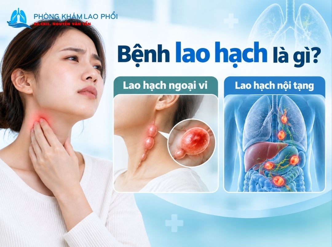 Lao hạch là một dạng lao ngoài phổi, thường gây sưng hạch, đặc biệt ở vùng cổ