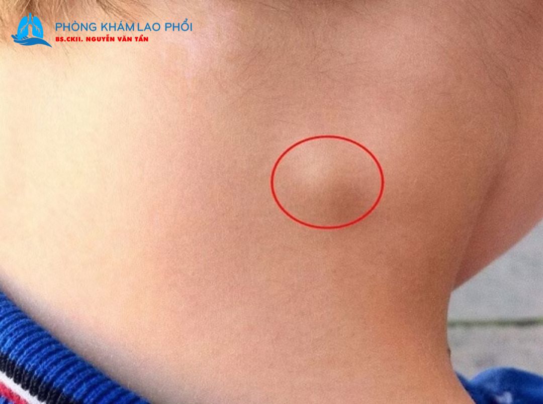 Lao hạch không quá nguy hiểm nếu được phát hiện sớm và điều trị đúng phác đồ