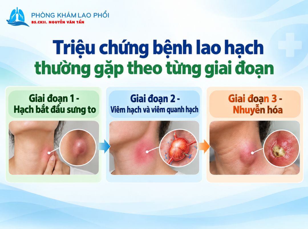 Các triệu chứng điển hình theo từng giai đoạn