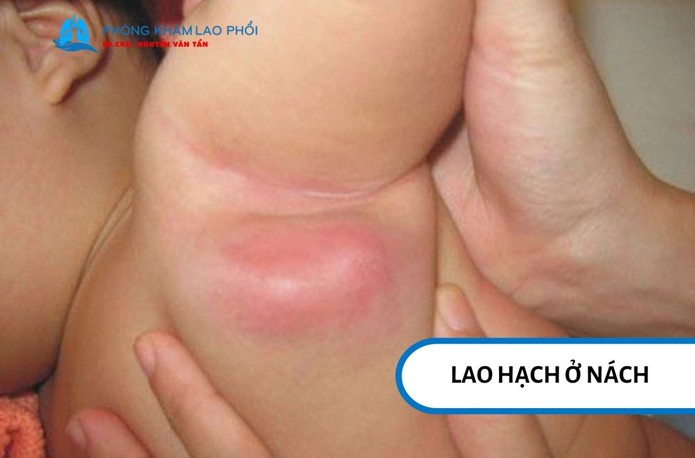 Lao hạch ở nách