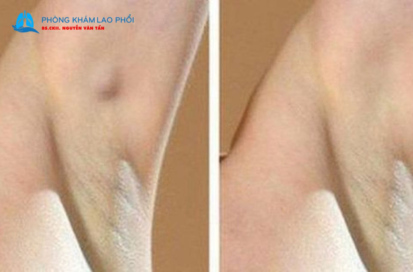 Dấu hiệu nhận biết lao hạch ở nách
