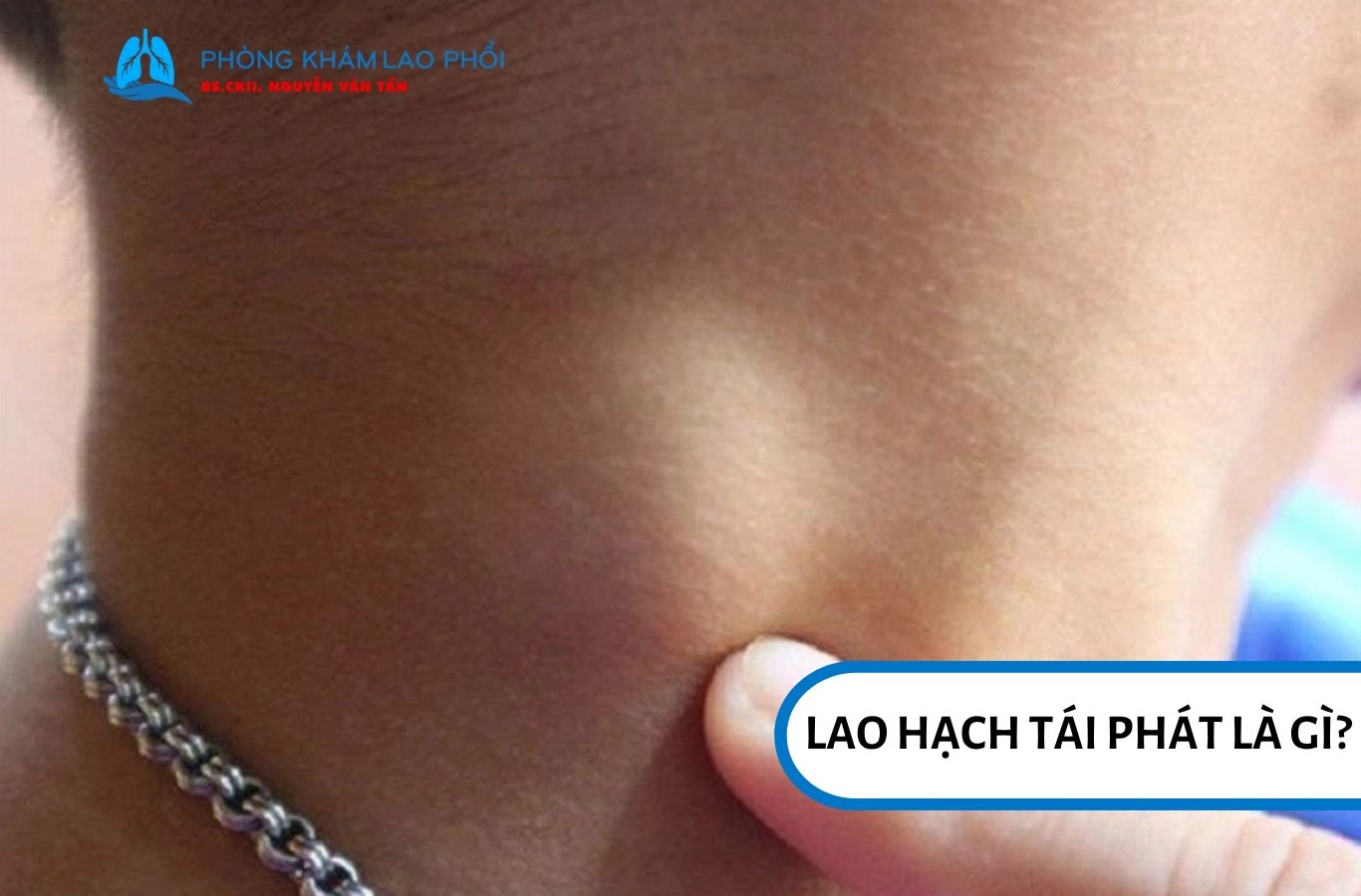 Lao hạch tái phát