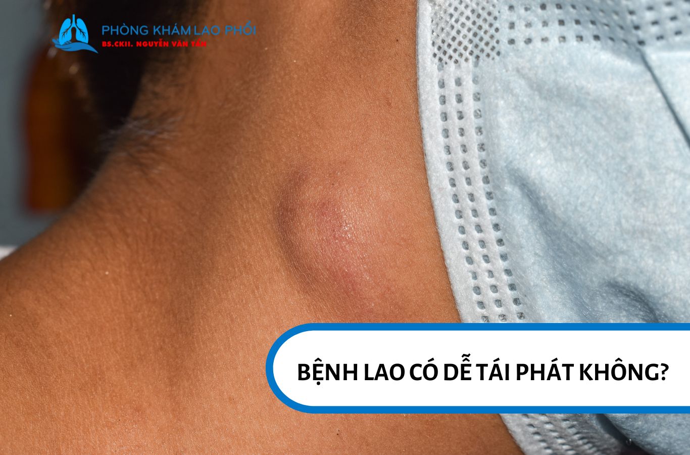 Bệnh lao có thể tái phát, nhưng không phải trường hợp nào cũng dễ tái phát