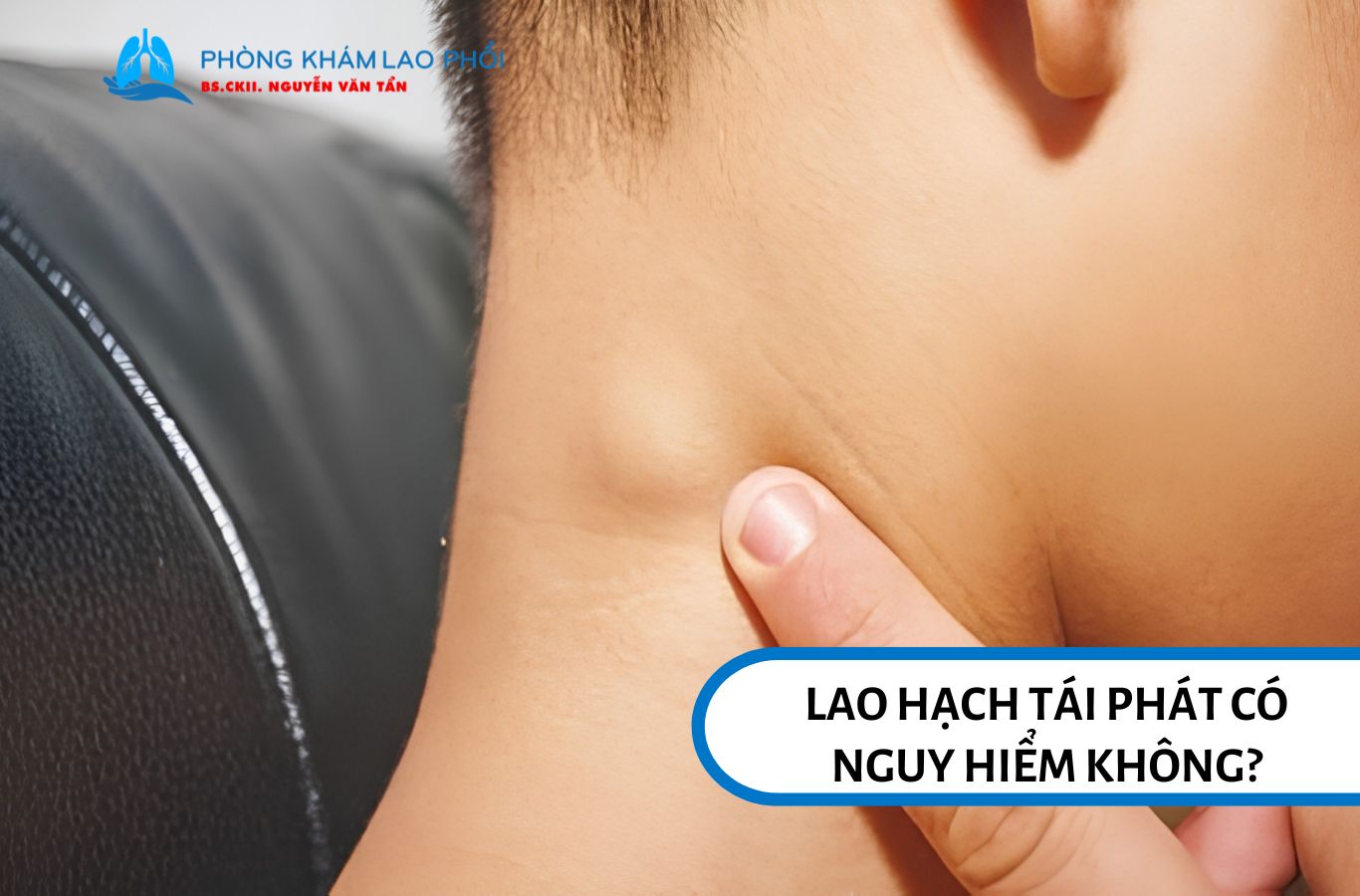 Lao hạch tái phát có thể nguy hiểm nếu không được phát hiện và điều trị kịp thời