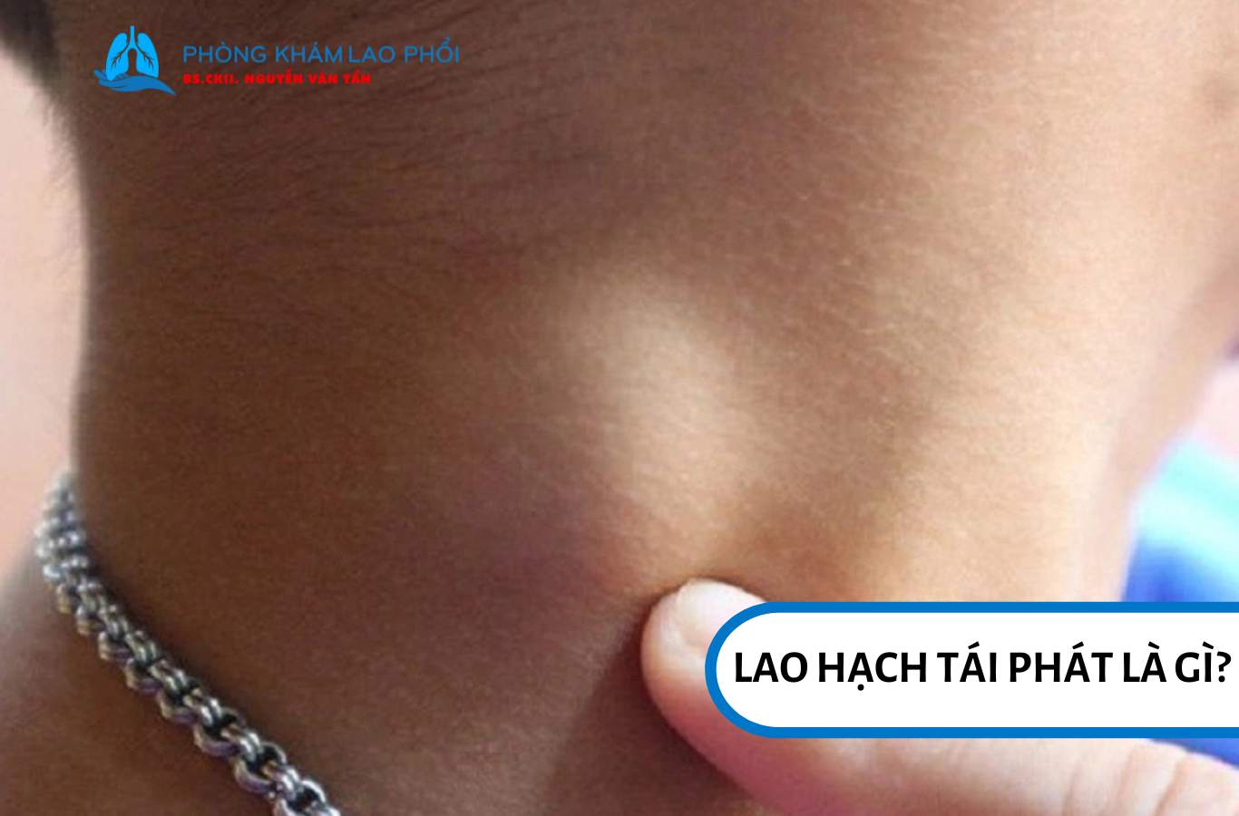 Lao hạch tái phát