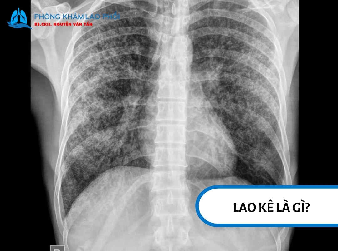 Lao kê là dạng bệnh lao lan tỏa rộng vào trong cơ thể người và tạo các tổn thương kích thước nhỏ
