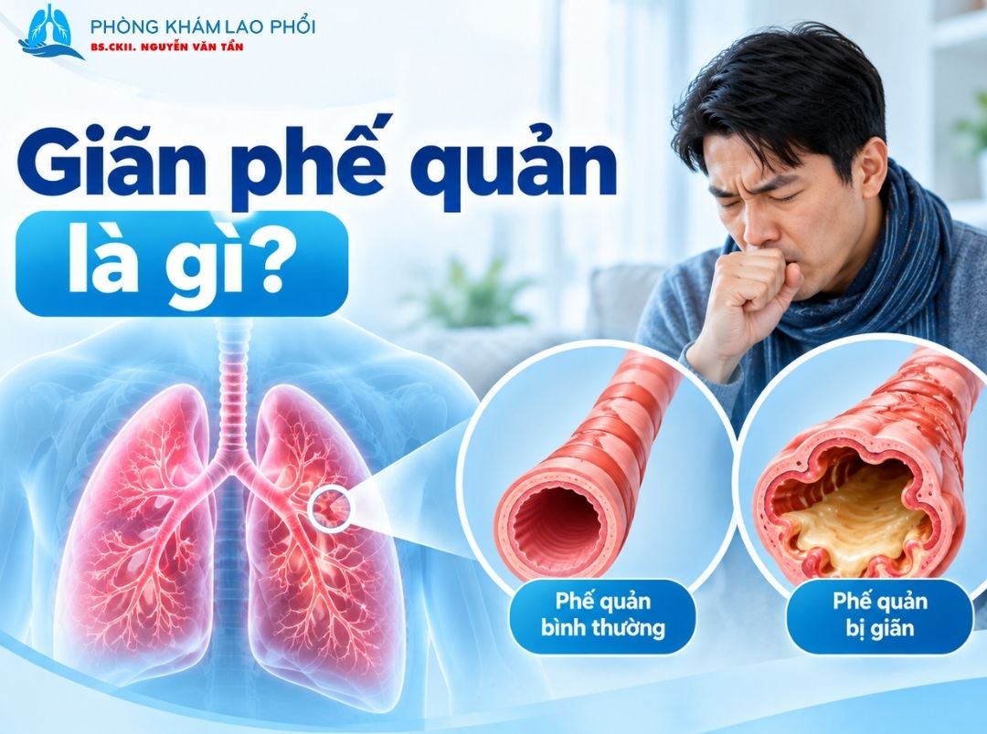 Giãn phế quản khiến đường thở giãn bất thường và dễ ứ đọng đờm