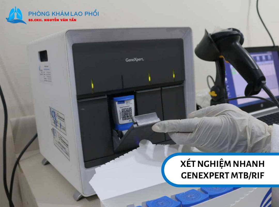 Xét nghiệm nhanh GeneXpert MTB/RIF là phương pháp được ưu tiên hàng đầu theo hướng dẫn của Bộ Y tế