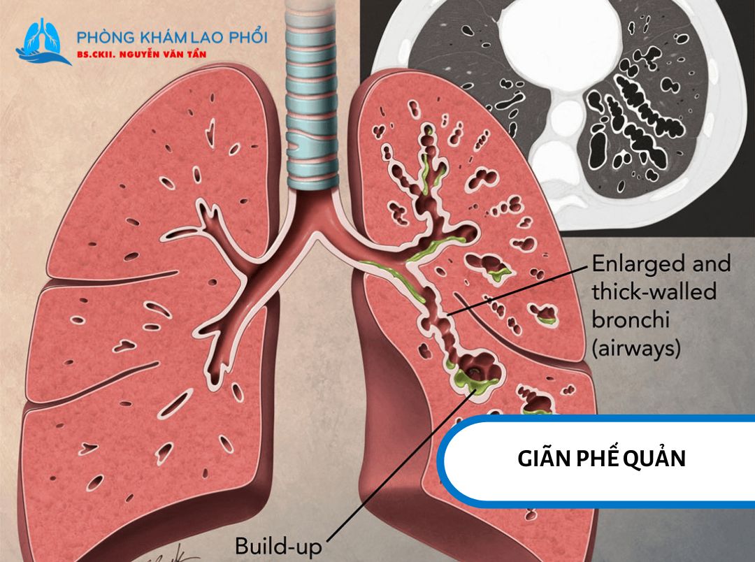 Khi phế quản bị giãn và tổn thương, khả năng đẩy chất nhầy ra ngoài suy giảm, khiến đờm dễ ứ đọng và tái nhiễm trùng