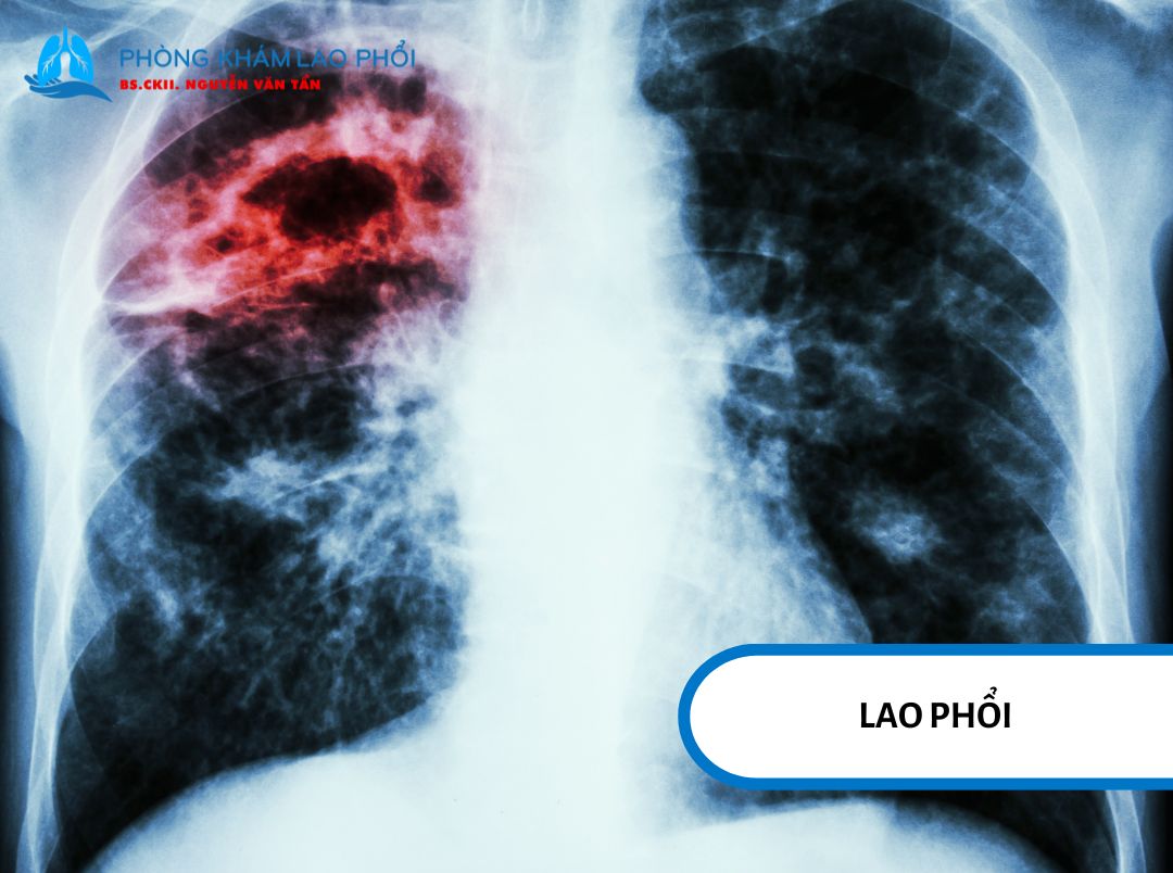 Khò khè là một trong những triệu chứng lao phổi có thể xuất hiện khi đường thở bị ảnh hưởng