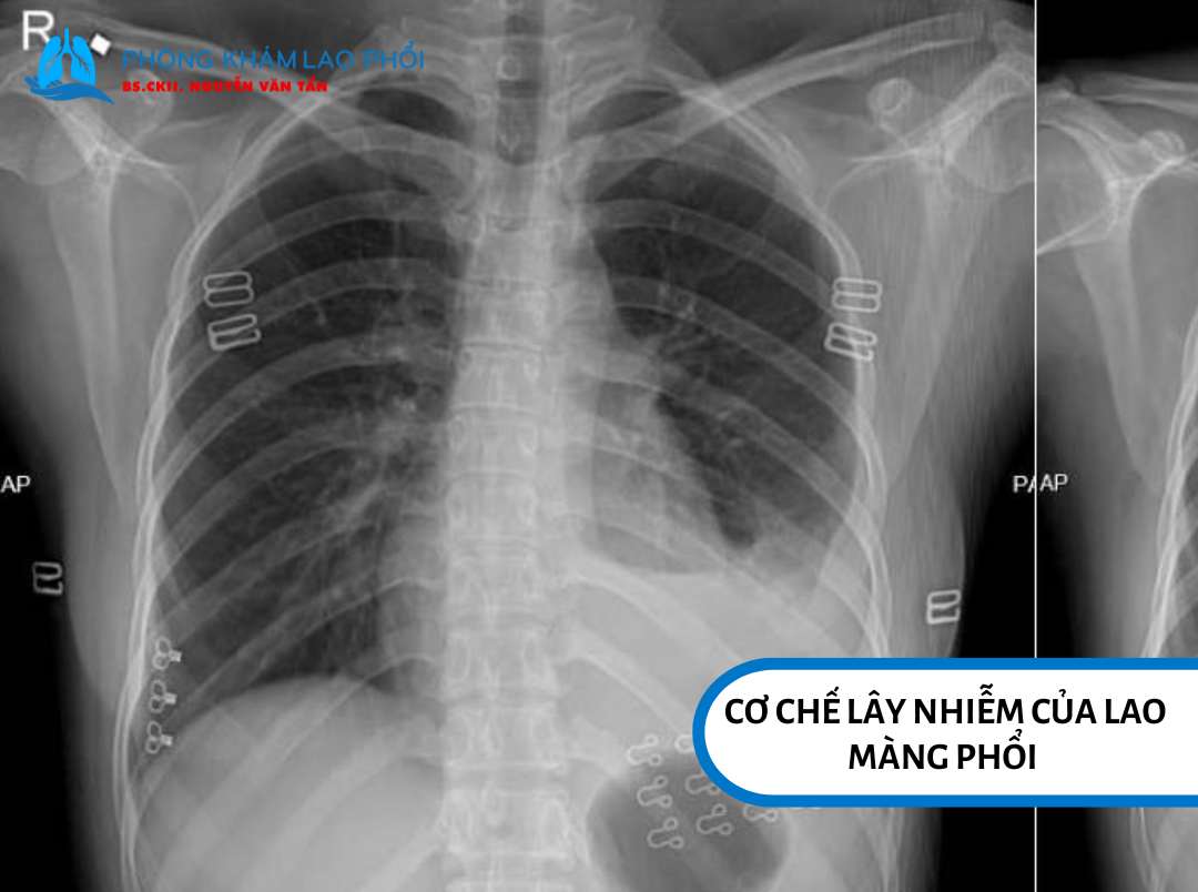 Hình ảnh lao màng phổi