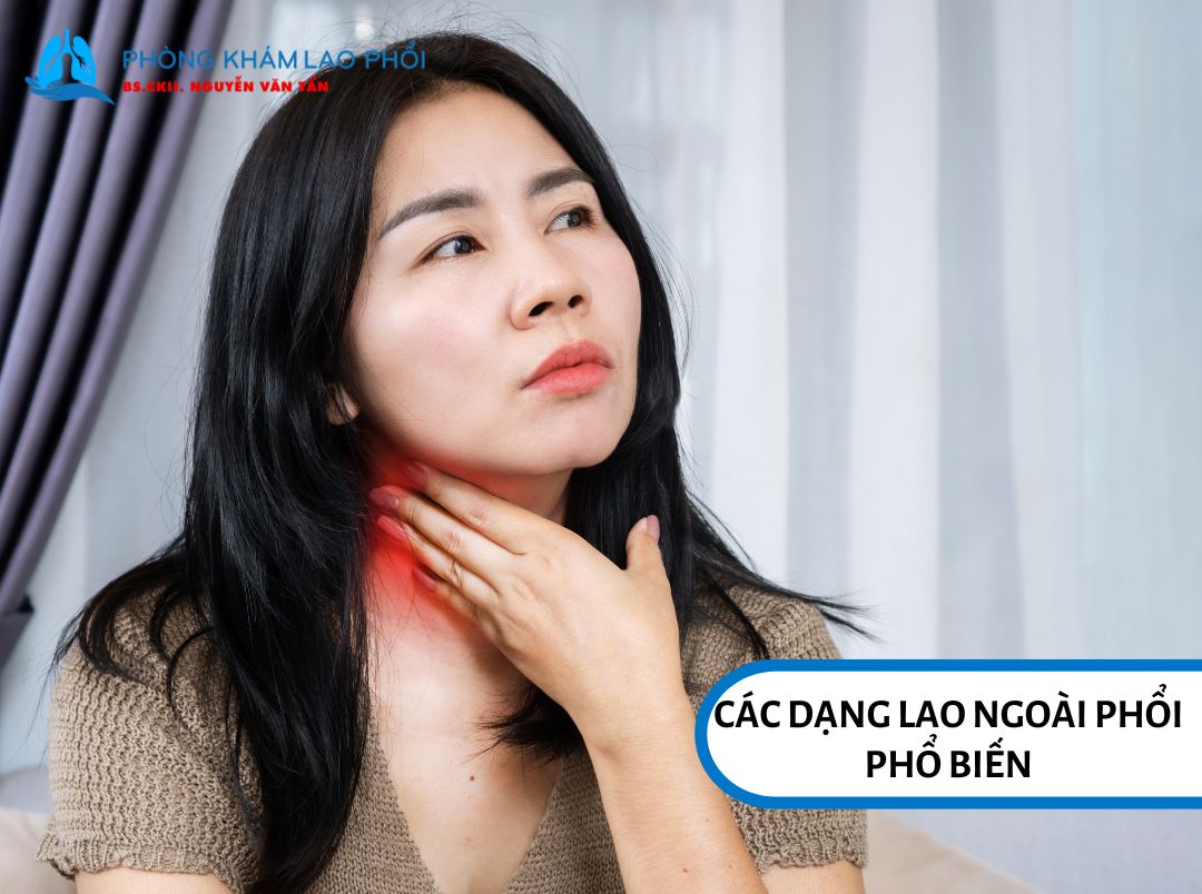 Lao hạch là một trong những dạng lao ngoài phổi phổ biến