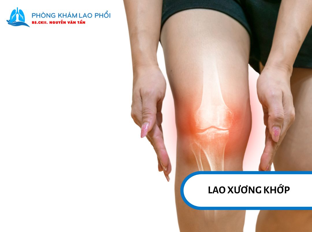 Lao xương khớp là một dạng lao ngoài phổi khá phổ biến