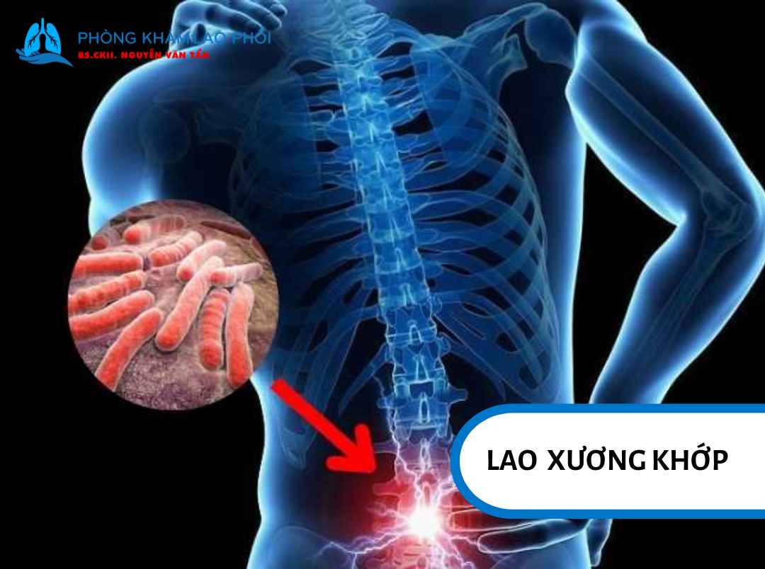 Lao xương khớp