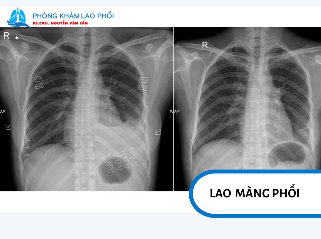 Lao màng phổi, xảy ra khi vi khuẩn lao gây viêm ở lớp màng bao quanh phổi