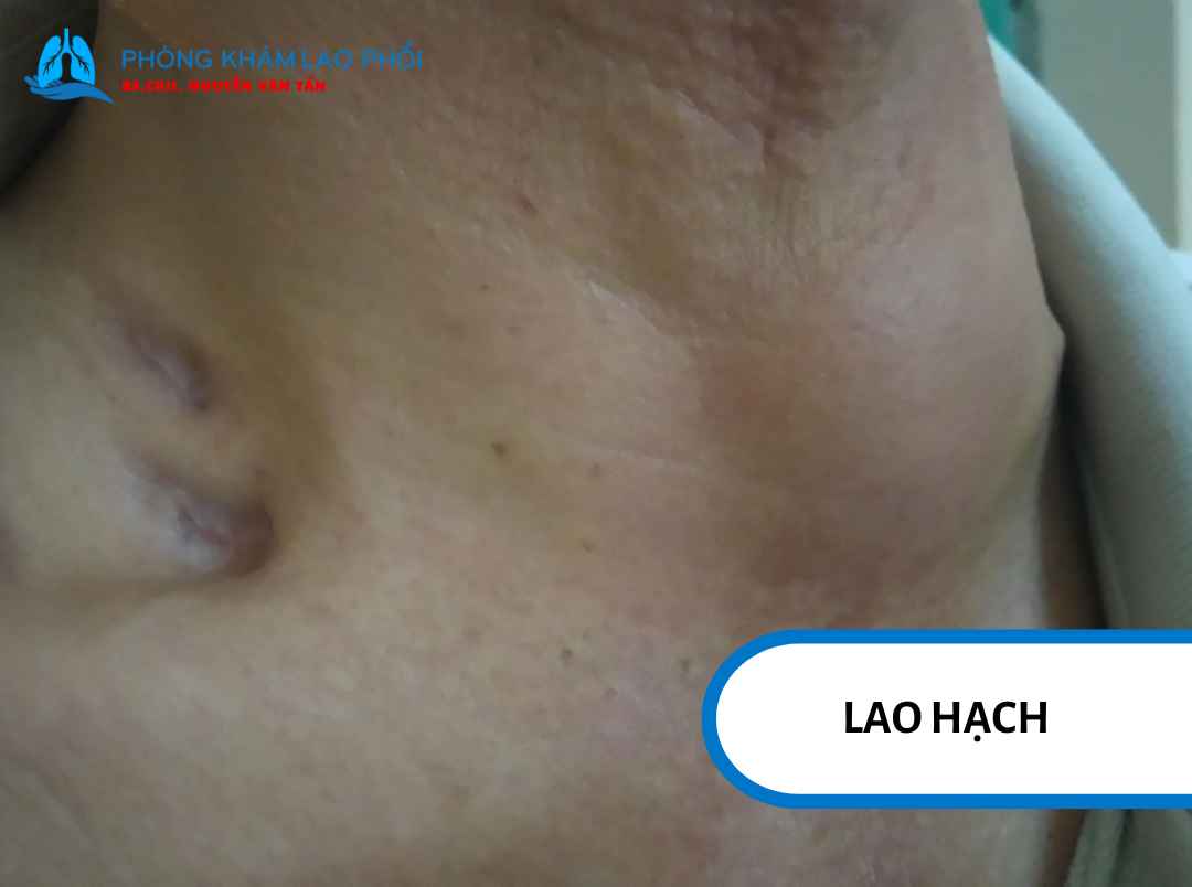 Lao hạch