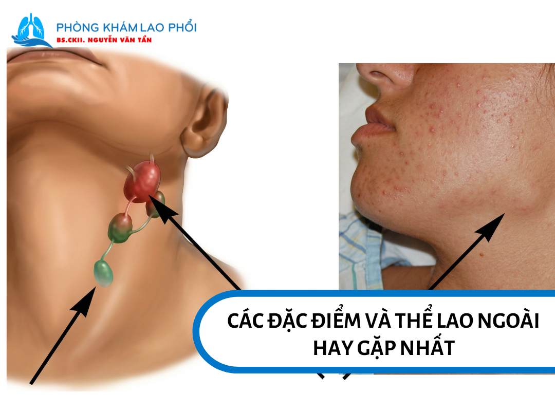 Lao ngoài phổi là tình trạng vi khuẩn lao gây tổn thương ở các cơ quan khác ngoài phổi