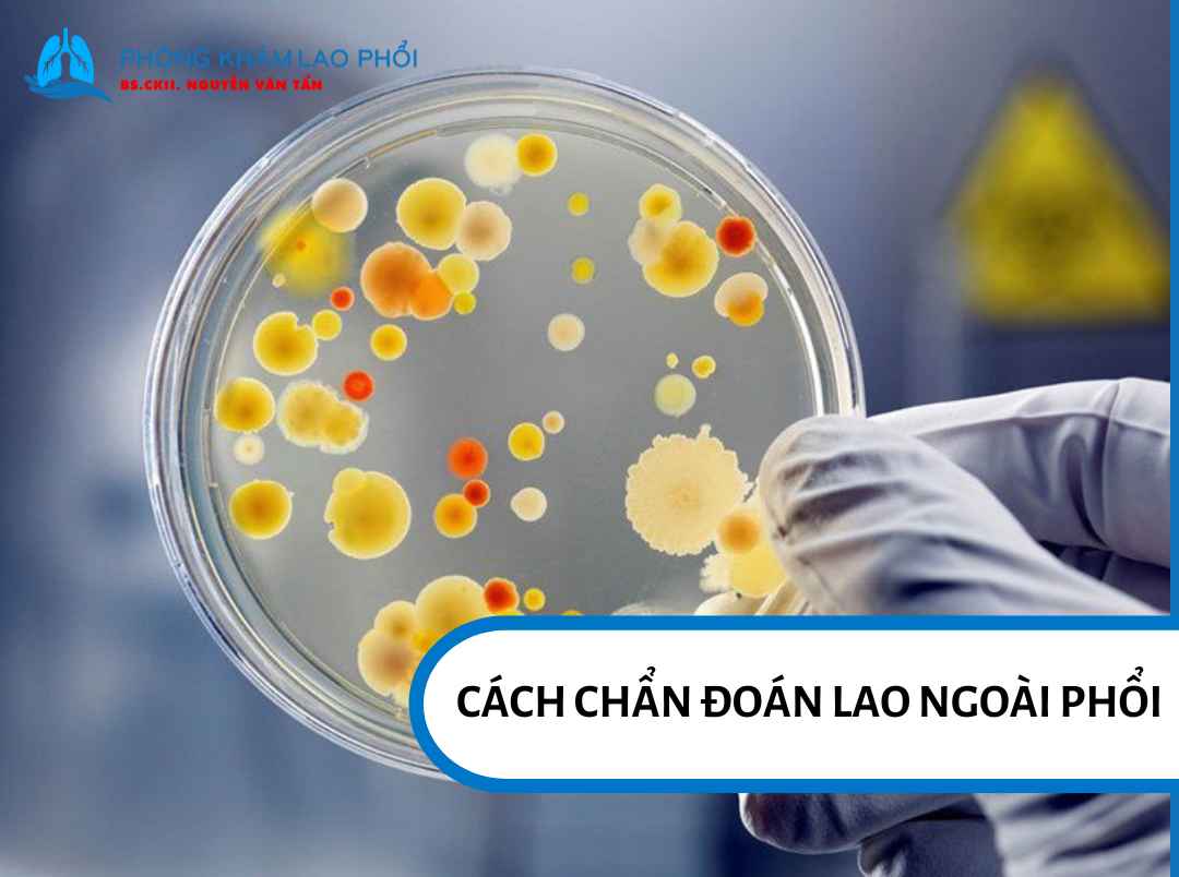Xét nghiệm vi khuẩn học và sinh học phân tử để tìm vi khuẩn lao
