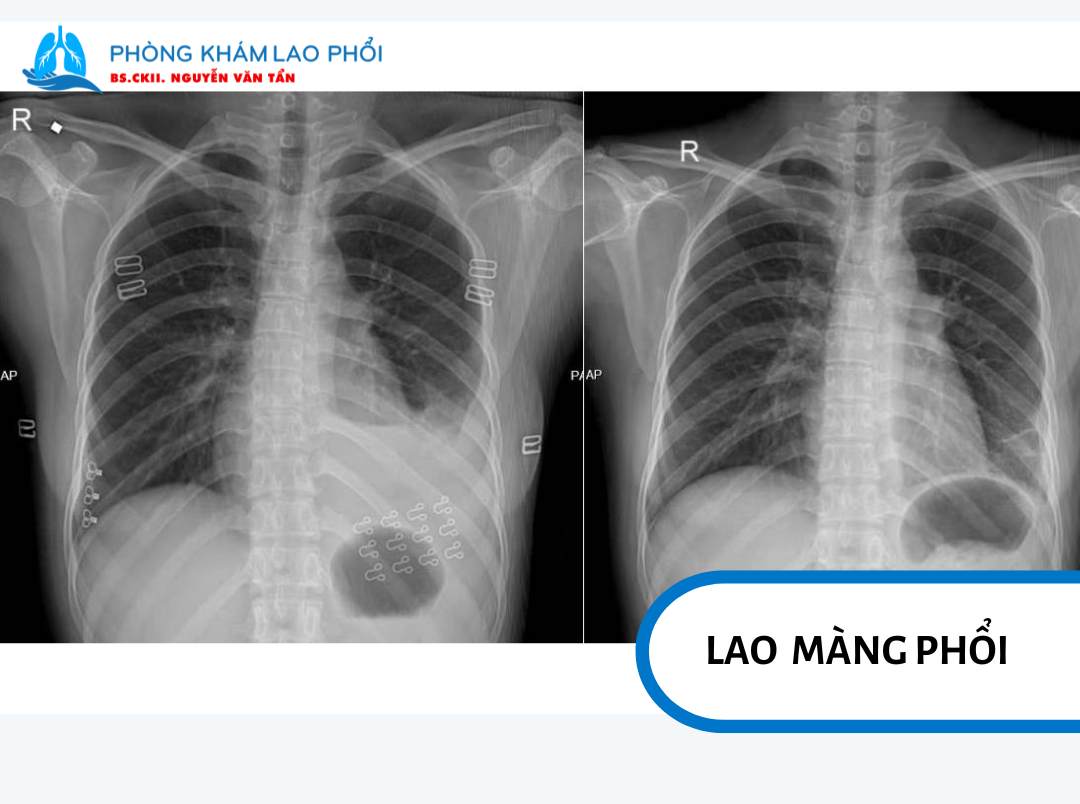 Lao màng phổi, xảy ra khi vi khuẩn lao gây viêm ở lớp màng bao quanh phổi