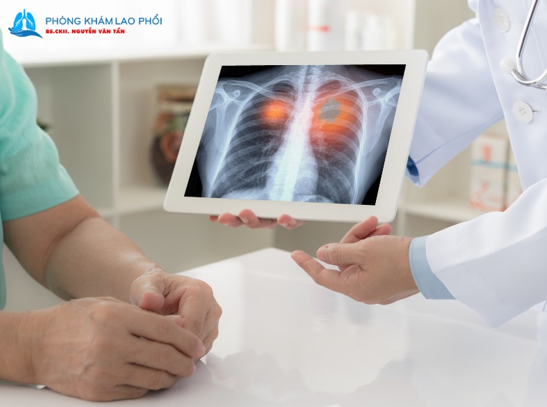 Cách chẩn đoán bệnh lao phổi