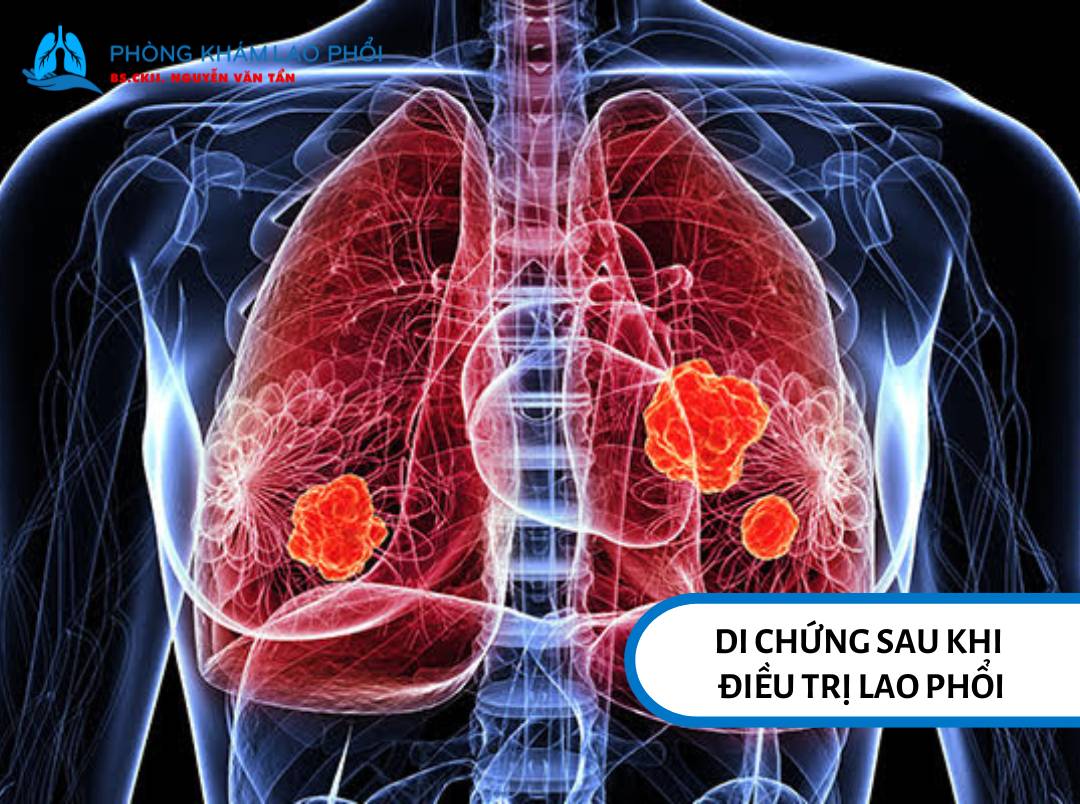 Tổn thương nhu mô phổi là một trong những di chứng có thể xảy ra sau khi trị lao phổi