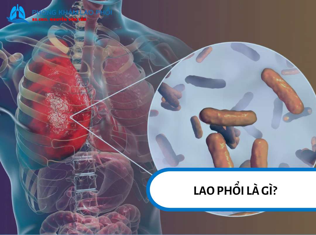 Lao phổi là bệnh truyền nhiễm do vi khuẩn tấn công phổi và lây qua không khí, nhưng có thể chữa khỏi nếu phát hiện sớm