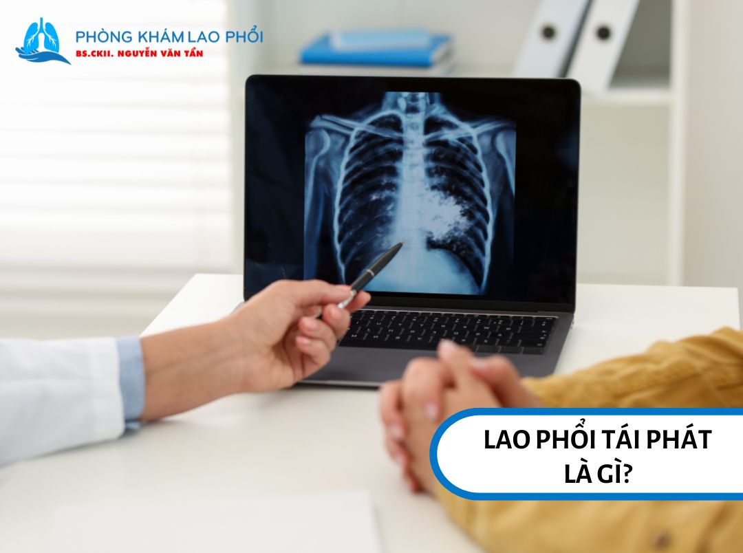 Lao phổi tái phát xuất hiện khi người bệnh được chẩn đoán mắc lao trở lại sau khi đã điều trị khỏi trước đó