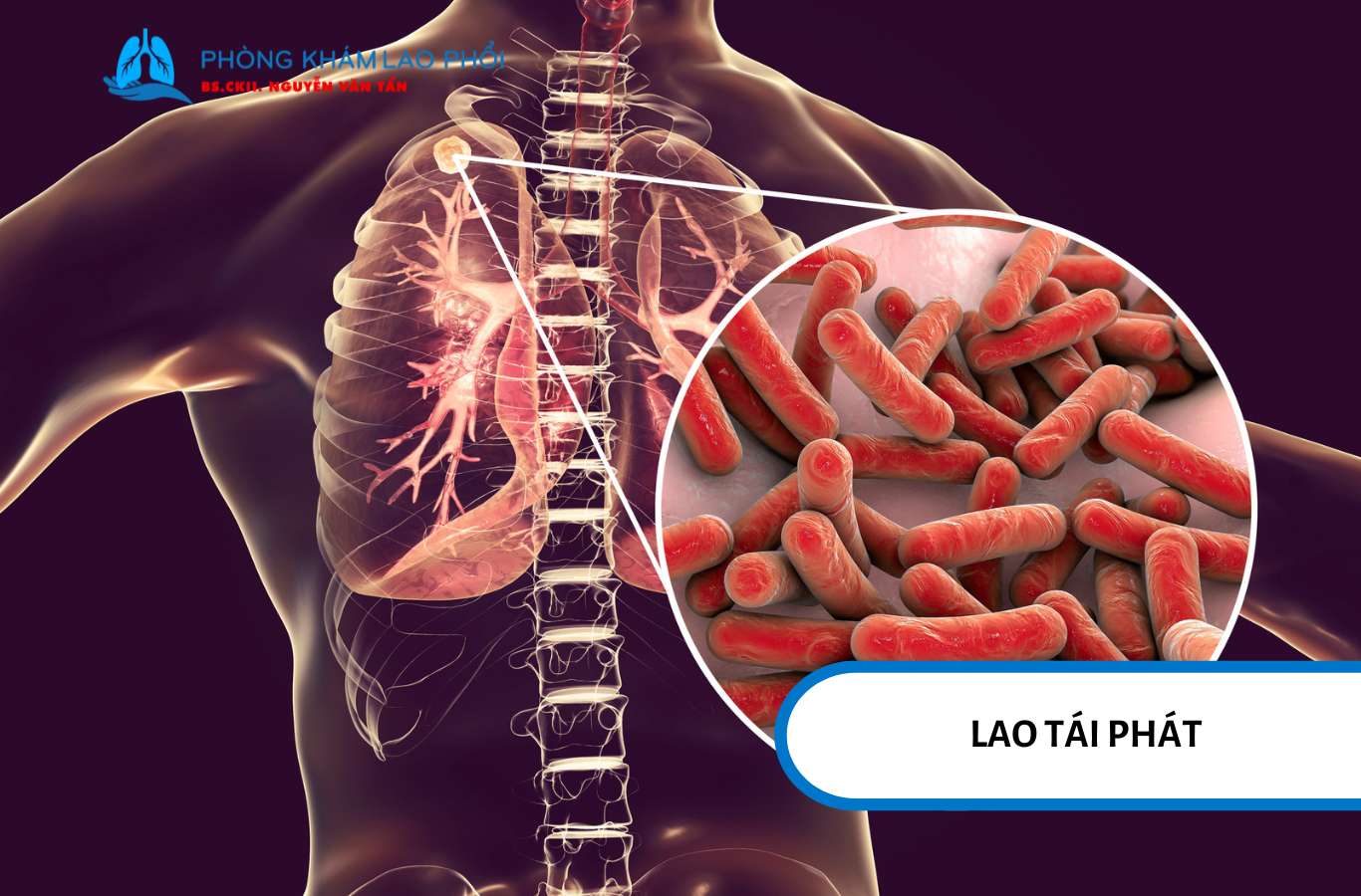 Lao tái phát xảy ra khi vi khuẩn lao còn tồn tại trong cơ thể và được kích hoạt trở lại