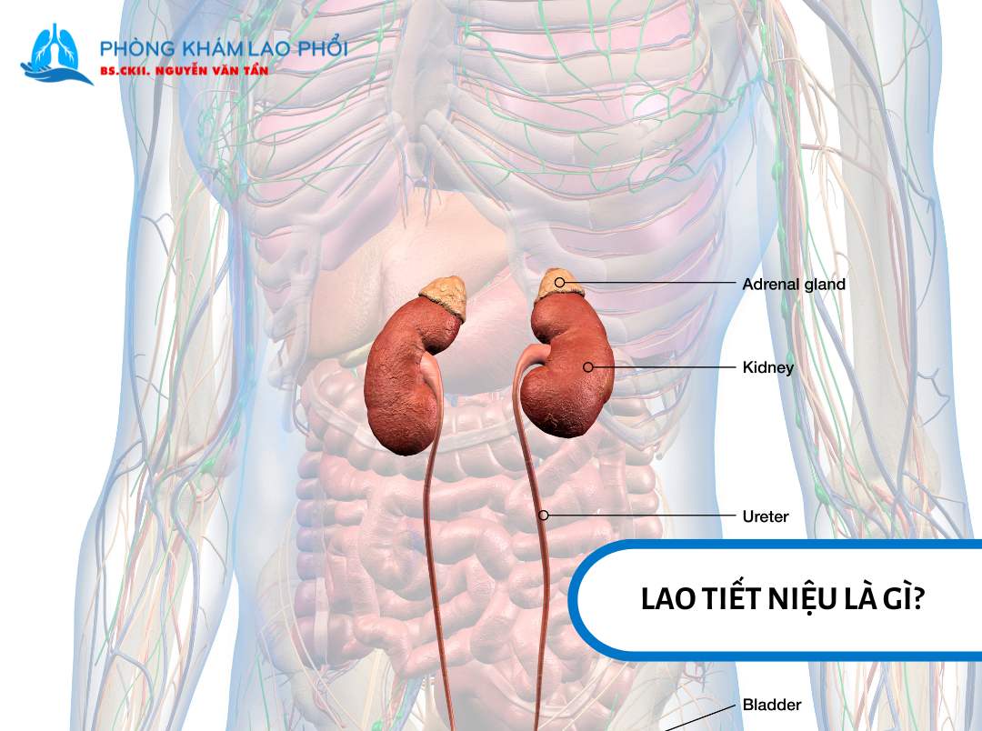 Lao tiết niệu xảy ra khi vi khuẩn lao xâm nhập vào hệ tiết niệu, bao gồm thận, niệu quản, bàng quang