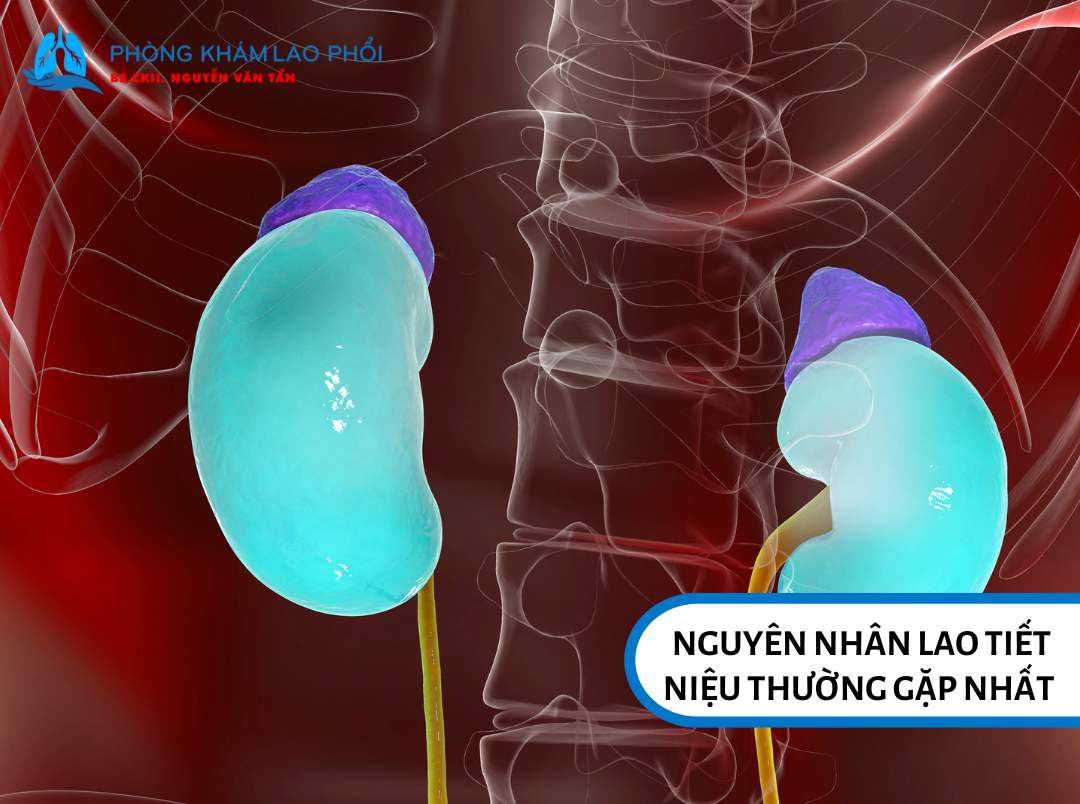 Nguyên nhân lao tiết niệu thường gặp  