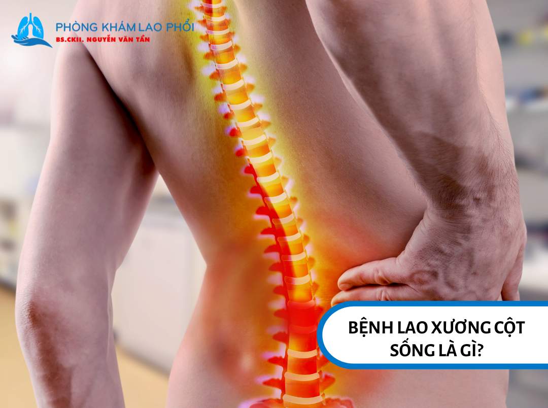 Bệnh lao xương cột sống là một dạng lao ngoài phổi, xảy ra khi vi khuẩn lao tấn công vào các đốt sống, đặc biệt là vùng ngực và thắt lưng.