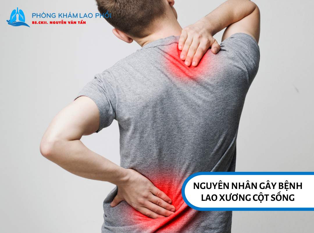 Nguyên nhân gây bệnh lao xương cột sống là do vi khuẩn lao gây tổn thương tại vùng thân đốt sống