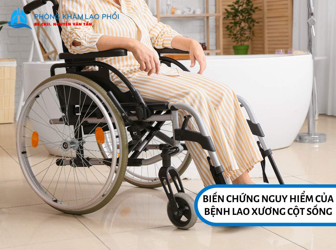 Biến chứng nguy hiểm của bệnh lao xương cột sống