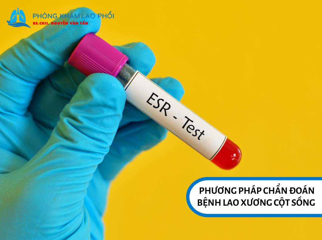 Xét nghiệm máu là một trong những cách chẩn đoán bệnh lao xương cột sống