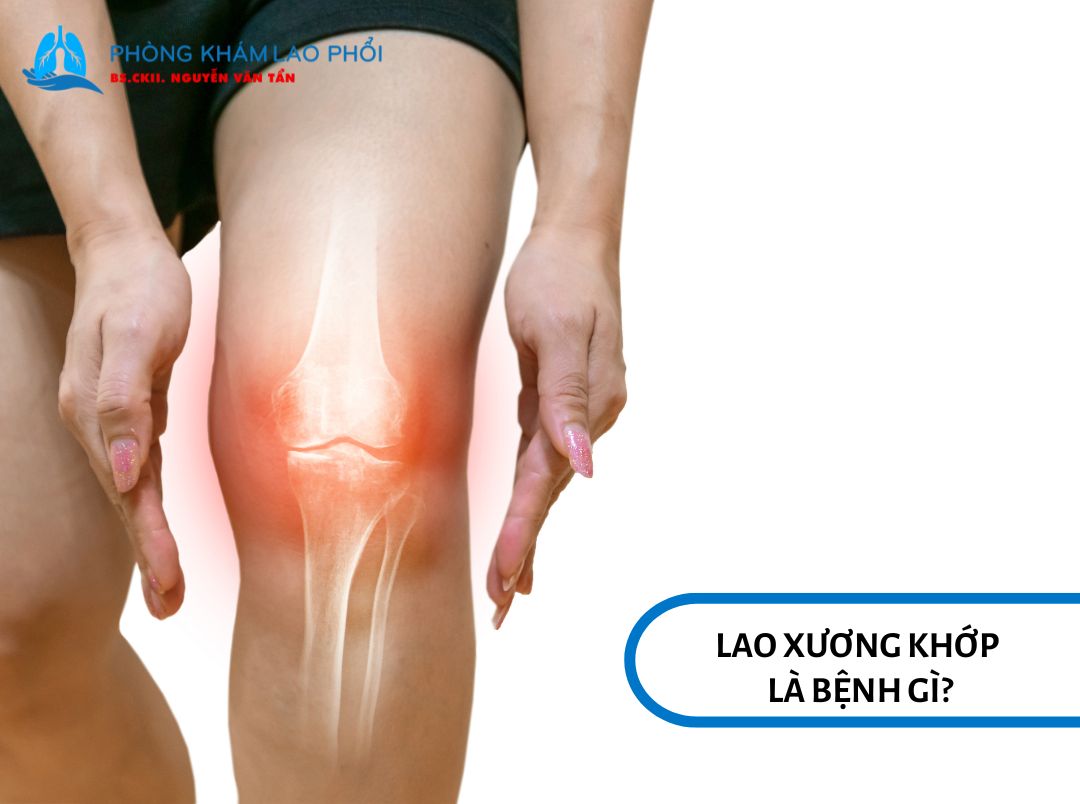 Lao xương khớp là bệnh nhiễm khuẩn mạn tính do vi khuẩn lao gây ra