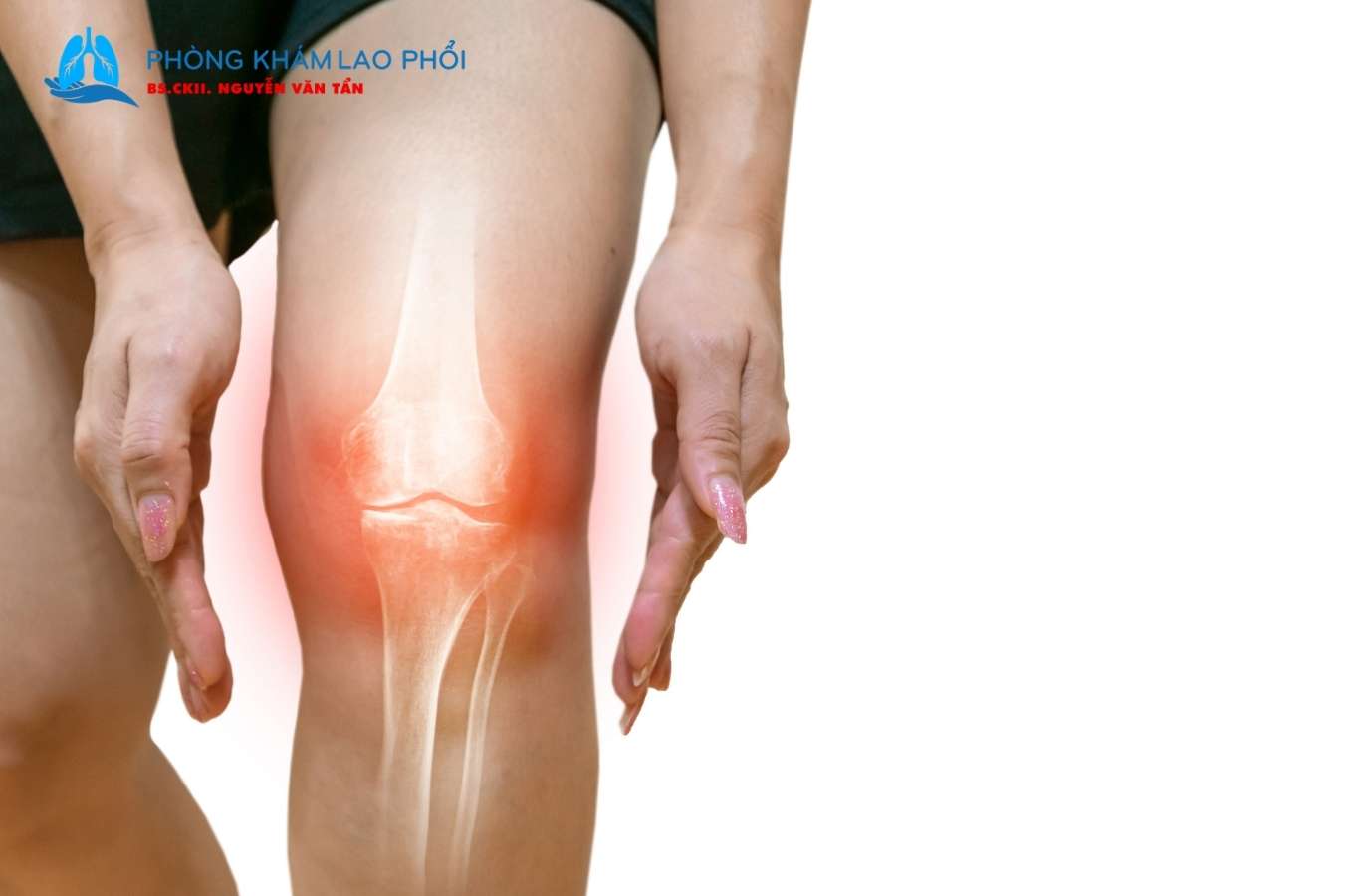 Lao xương khớp có lây không?