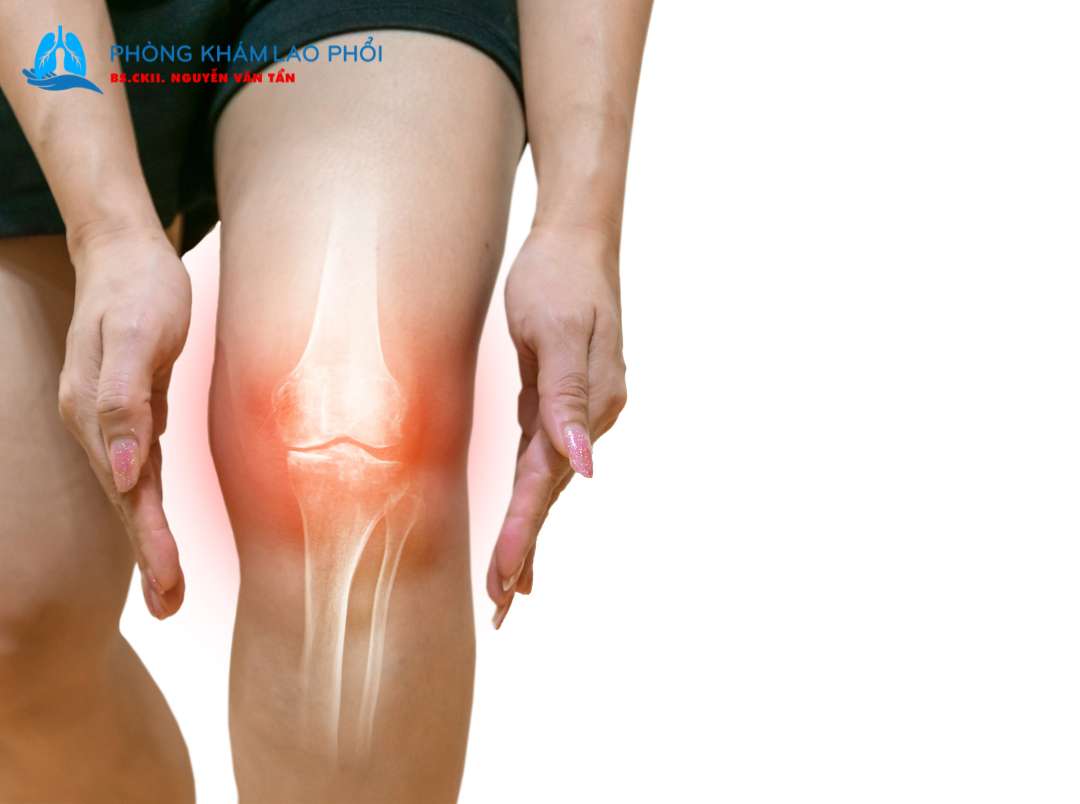 Lao xương khớp có lây không? 