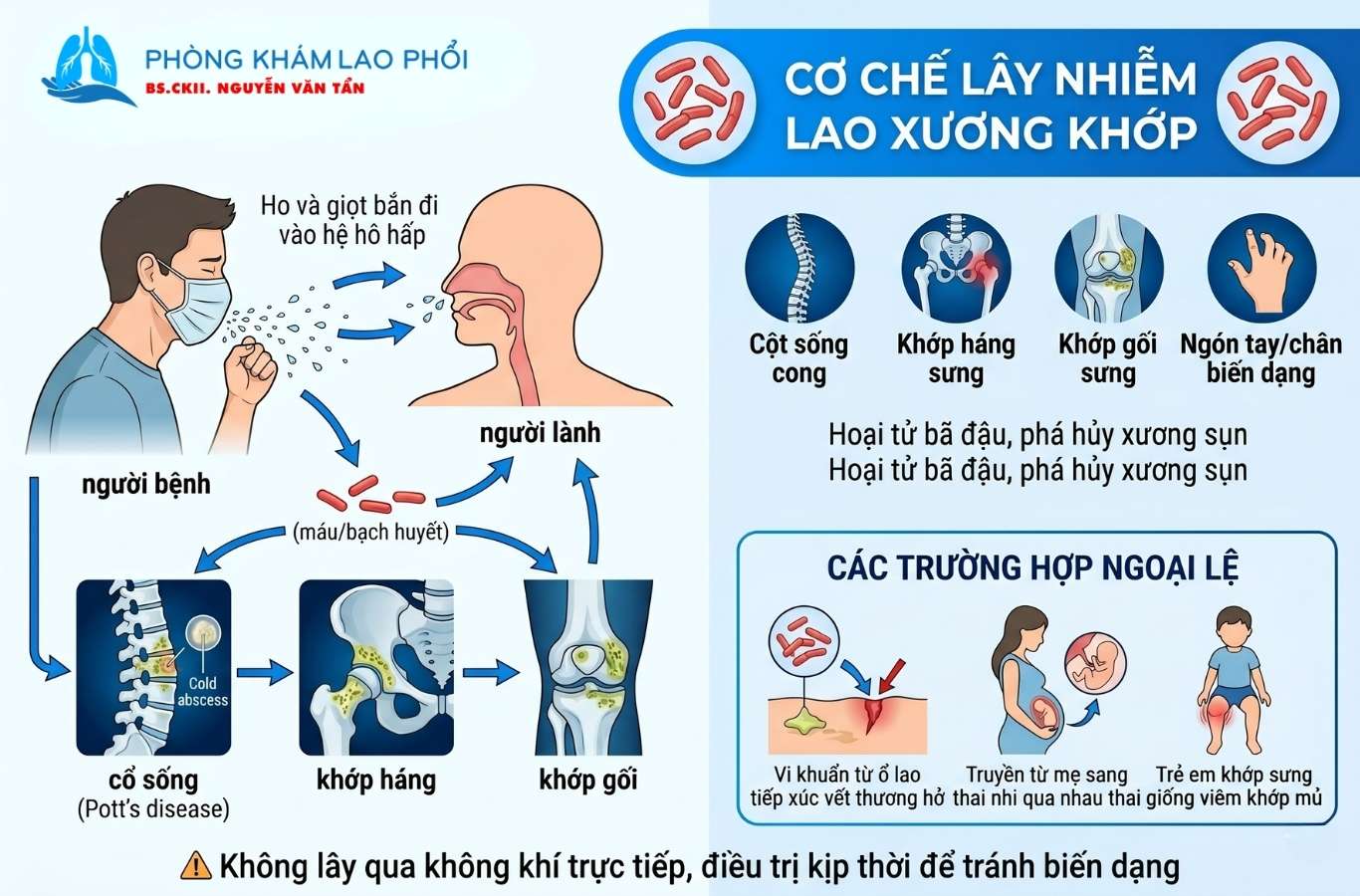Lao xương khớp lây chủ yếu qua đường hô hấp, rất hiếm khi lây trực tiếp