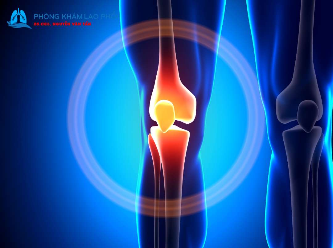 Cách phòng tránh bị bệnh lao xương khớp