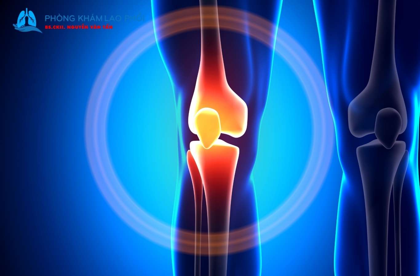 Tiêm BCG, giữ vệ sinh, tăng sức đề kháng để phòng tránh lao xương khớp
