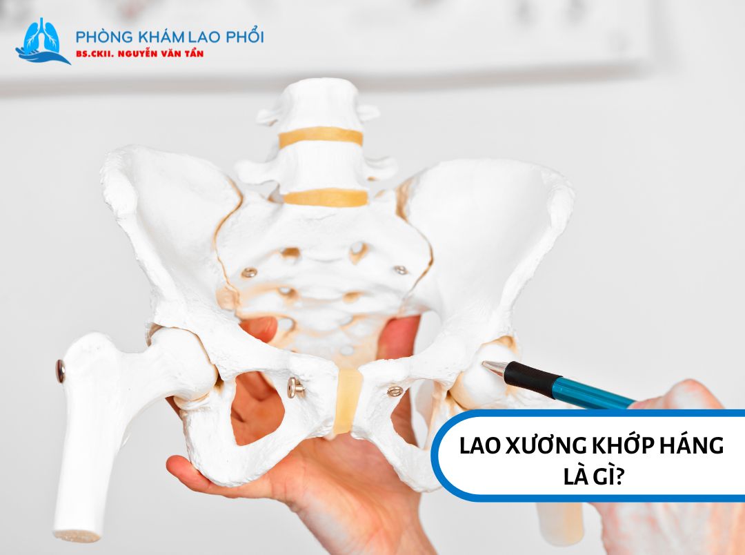 Lao xương khớp háng là một dạng lao ngoài phổi