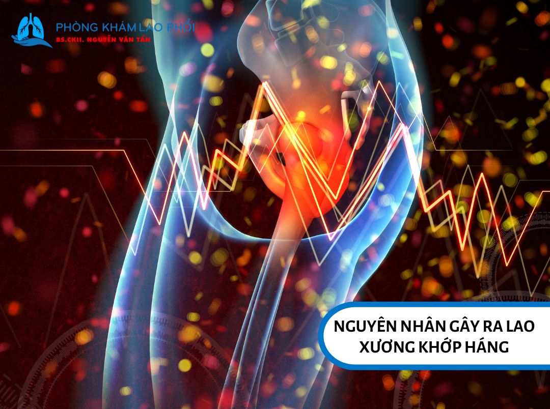Nguyên nhân chính gây ra lao xương khớp háng