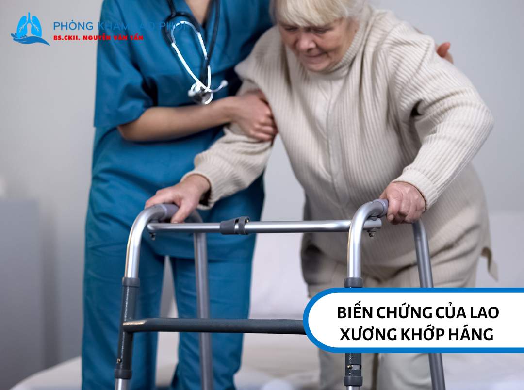 Biến chứng của lao xương khớp háng nếu không điều trị kịp thời