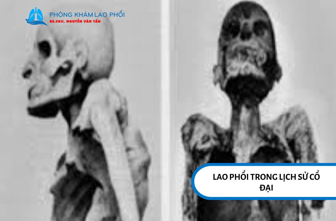 Xác ướp Ai Cập hé lộ lao cột sống, chứng tỏ bệnh lao đã tồn tại hàng nghìn năm