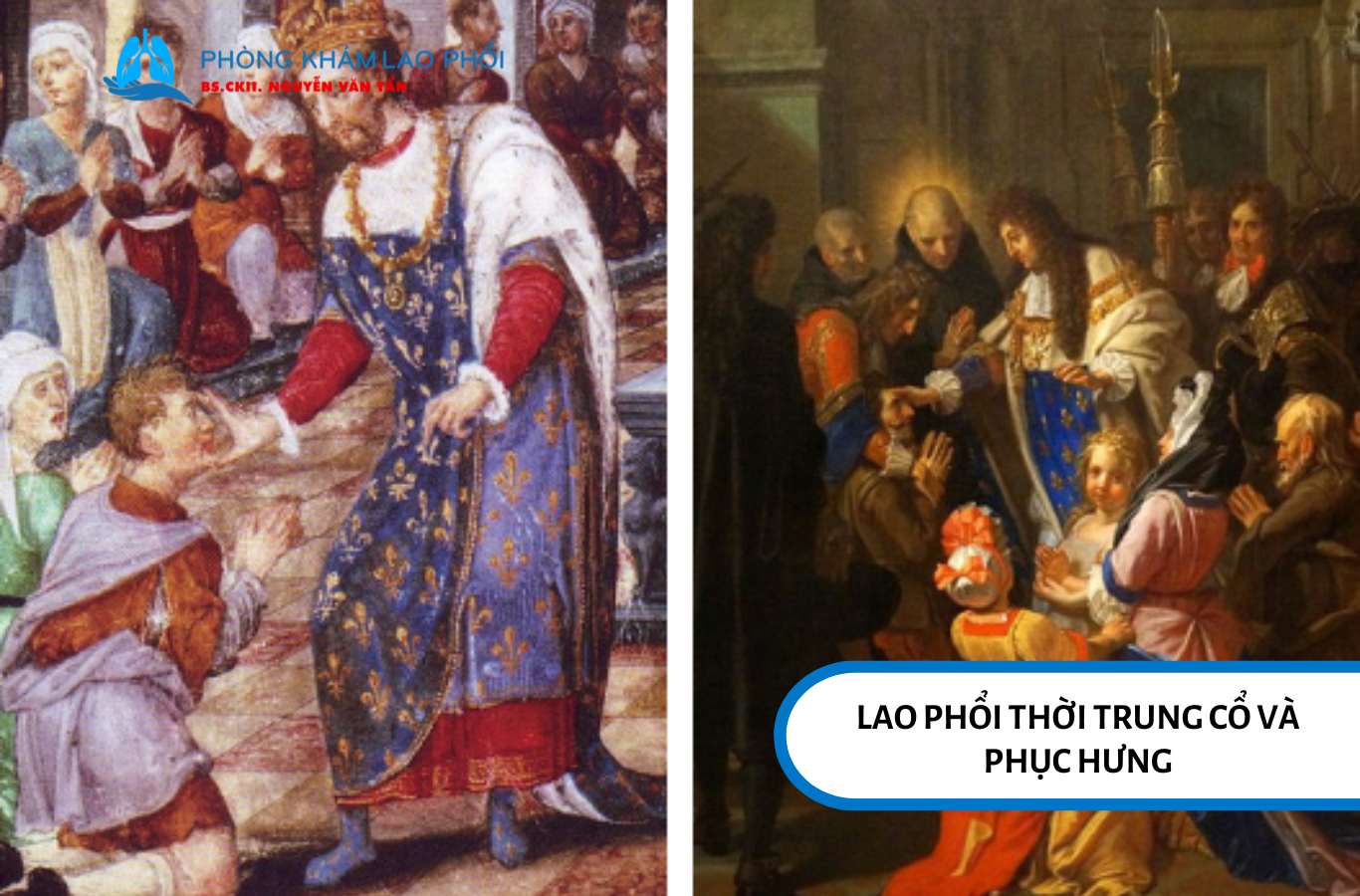 Trong thời Trung Cổ và thời kỳ Phục Hưng, người ta tin rằng tiếp xúc với vua sẽ giúp chữa khỏi một dạng lao ngoài phổi