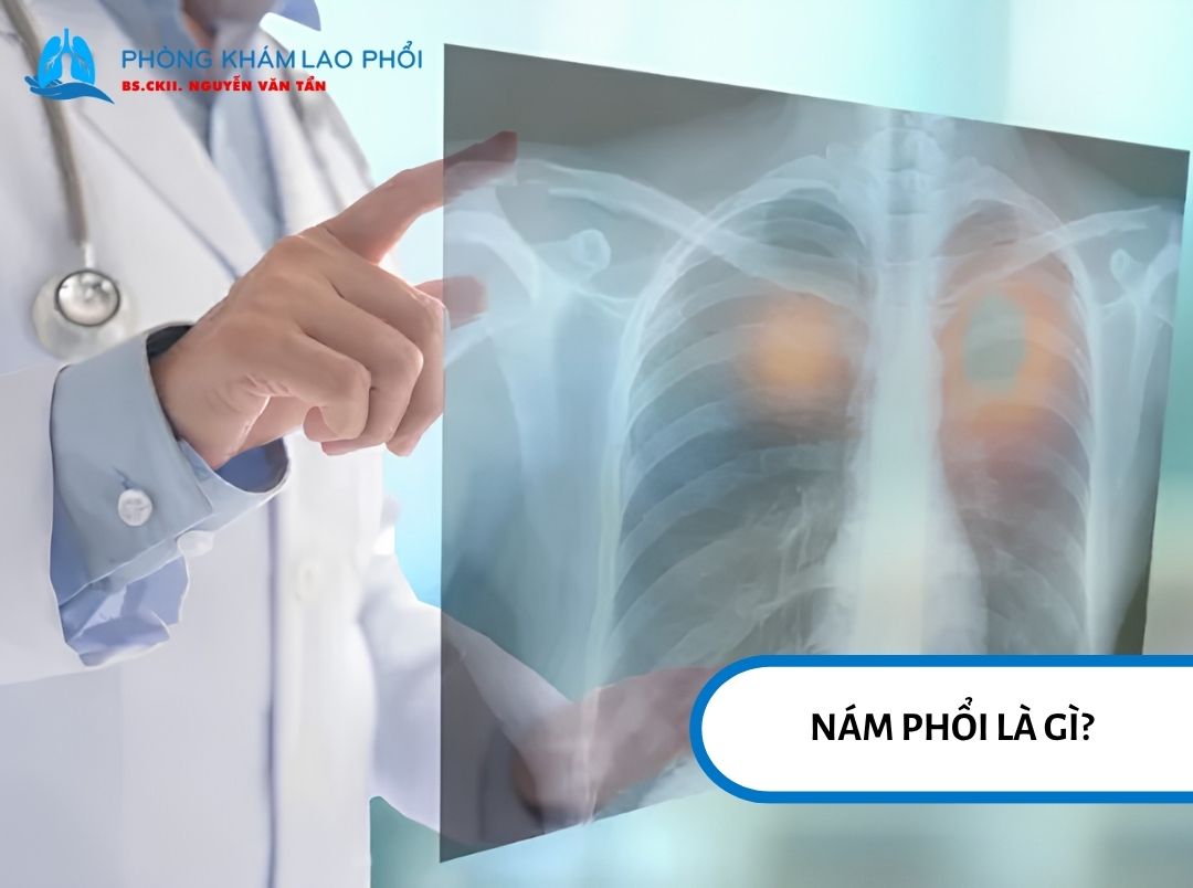 Nám phổi là tình trạng xuất hiện vùng mờ bất thường trên phim X-quang hoặc CT ngực