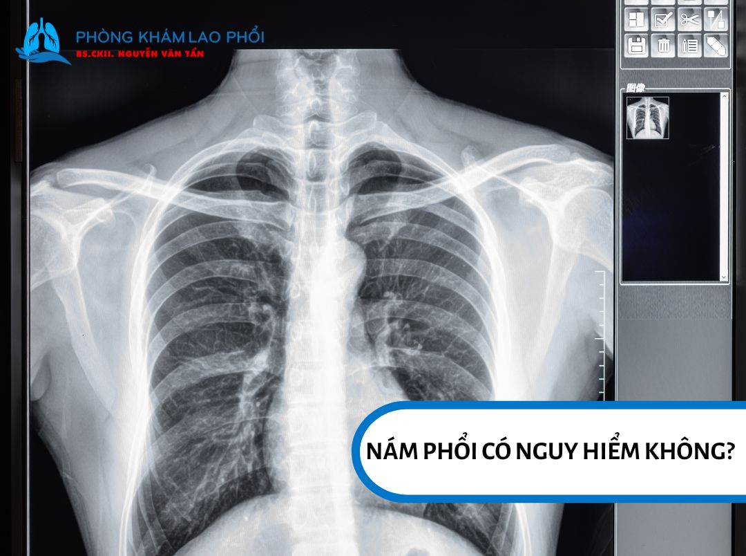 Nám phổi có thể nguy hiểm nếu tổn thương lan rộng hoặc ảnh hưởng đến hô hấp