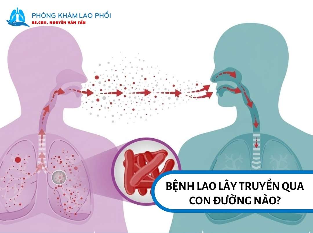 Bệnh lao lây truyền chủ yếu qua đường hô hấp