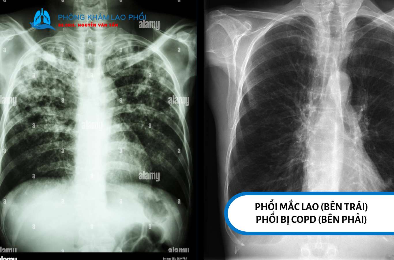 Tình trạng phổi khi mắc lao phổi và khi phổi bị tắc nghẽn mạn tính